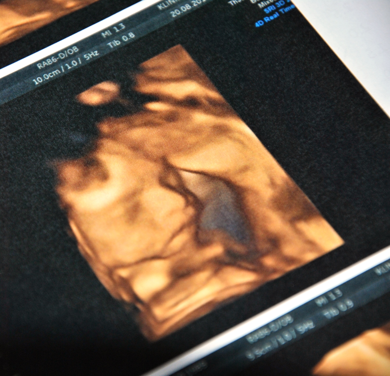 Badanie USG 3D i 4D niemowle